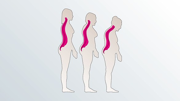 Columna en osteoporosis la la como tratar