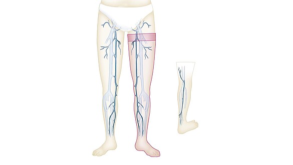 venas dilatadas en todo el cuerpo